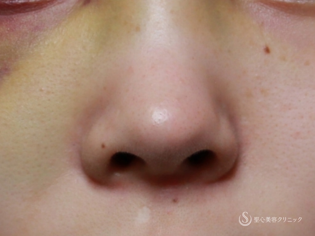 【10代女性・綺麗な鼻先に】オープン法による鼻尖縮小+鼻尖形成（３DPCLドーム）（1ヶ月後） Before 