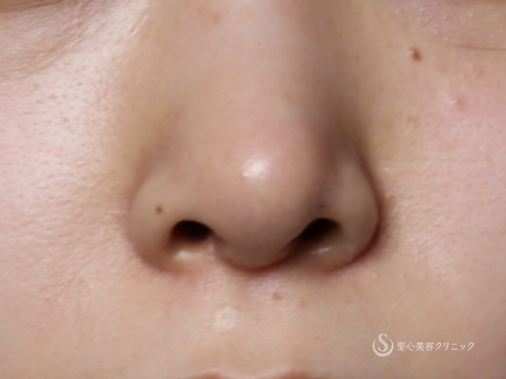 【10代女性・綺麗な鼻先に】オープン法による鼻尖縮小+鼻尖形成（３DPCLドーム）（1ヶ月後） After 