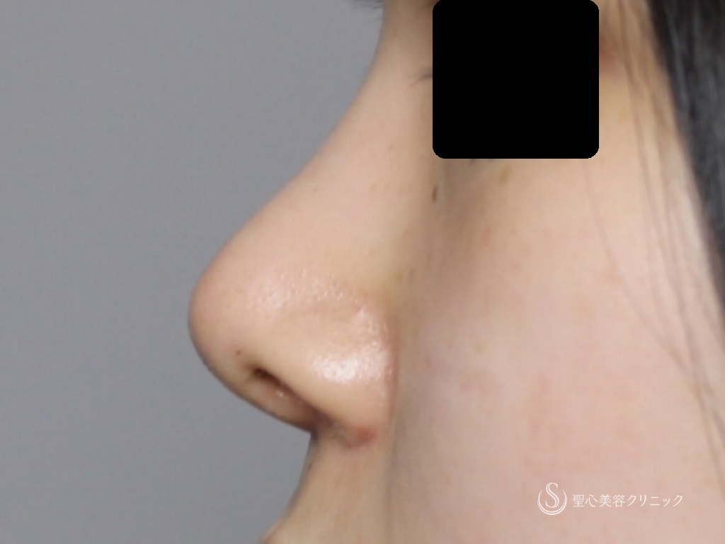 【10代女性・綺麗な鼻先に】オープン法による鼻尖縮小+鼻尖形成（３DPCLドーム）（1ヶ月後） After 