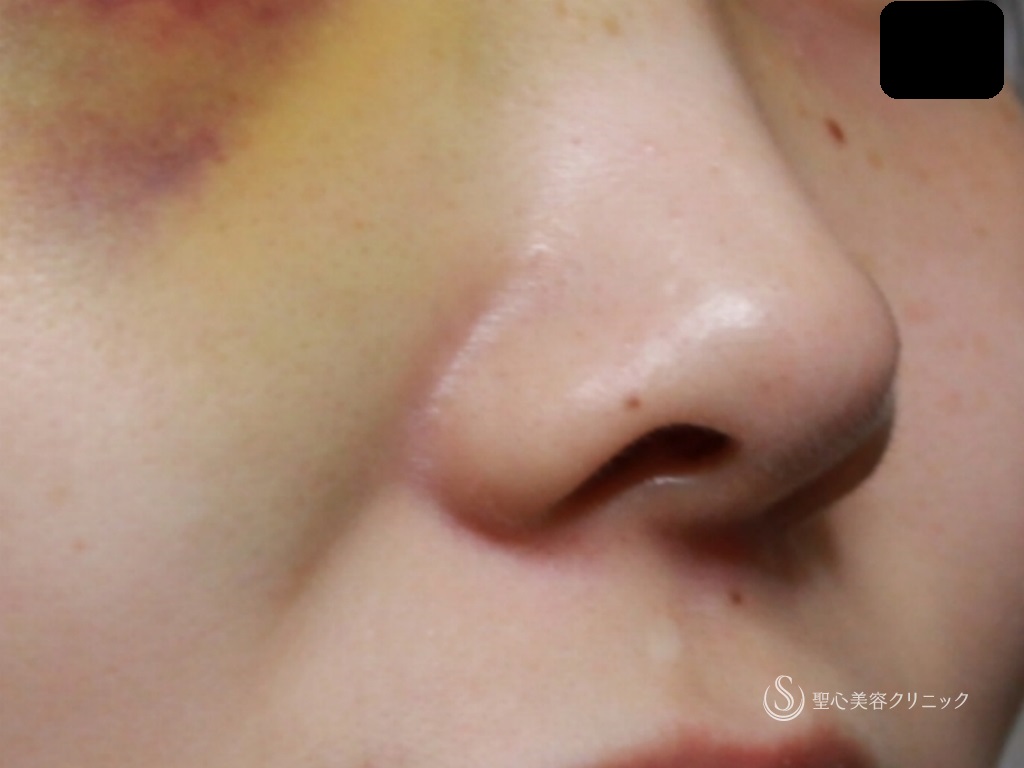 【10代女性・綺麗な鼻先に】オープン法による鼻尖縮小+鼻尖形成（３DPCLドーム）（1ヶ月後） Before 