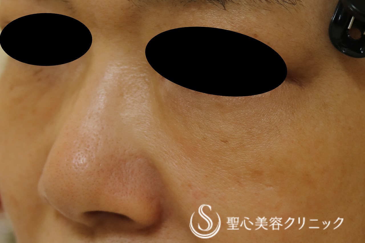 【60代女性・目の下、ほうれい線】プレミアムPRP皮膚再生療法（19か月後） After 