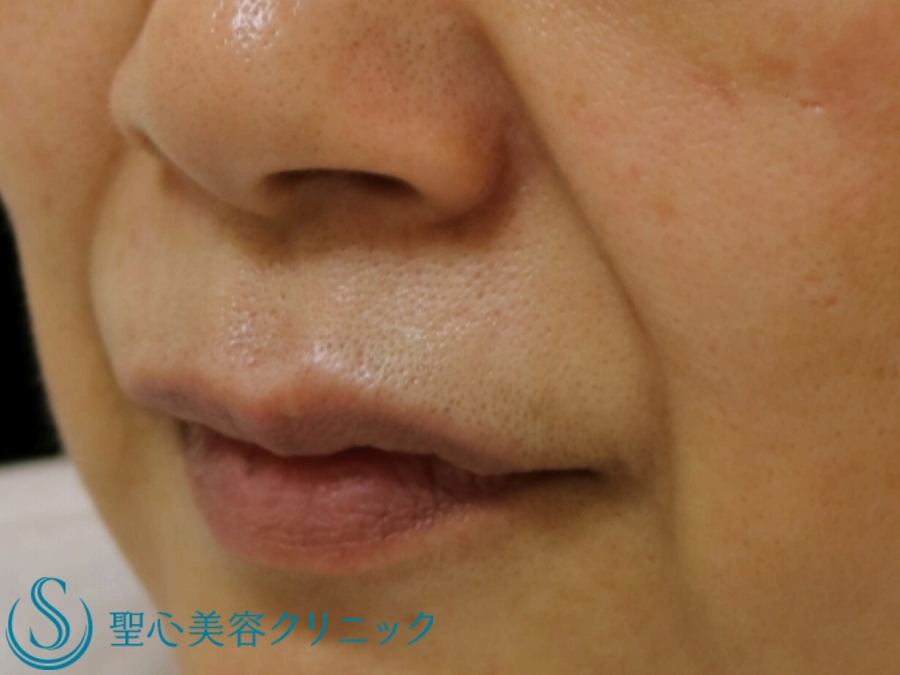【60代女性・目の下、ほうれい線】プレミアムPRP皮膚再生療法（19か月後） Before 
