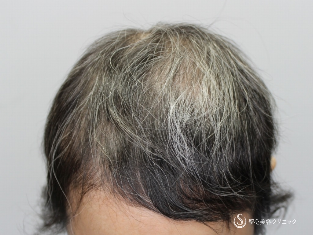 【40代女性・自分の毛を取り戻したい】毛髪複合治療 モニター（1年後） Before 