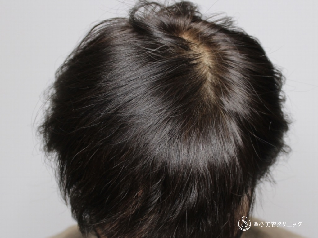 【40代女性・自分の毛を取り戻したい】毛髪複合治療 モニター（1年後） After 
