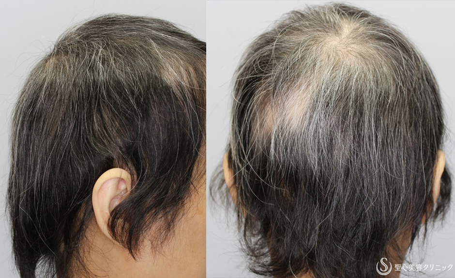 【40代女性・自分の毛を取り戻したい】毛髪複合治療 モニター（1年後） Before 