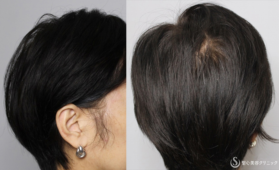 【40代女性・自分の毛を取り戻したい】毛髪複合治療 モニター（1年後） After 