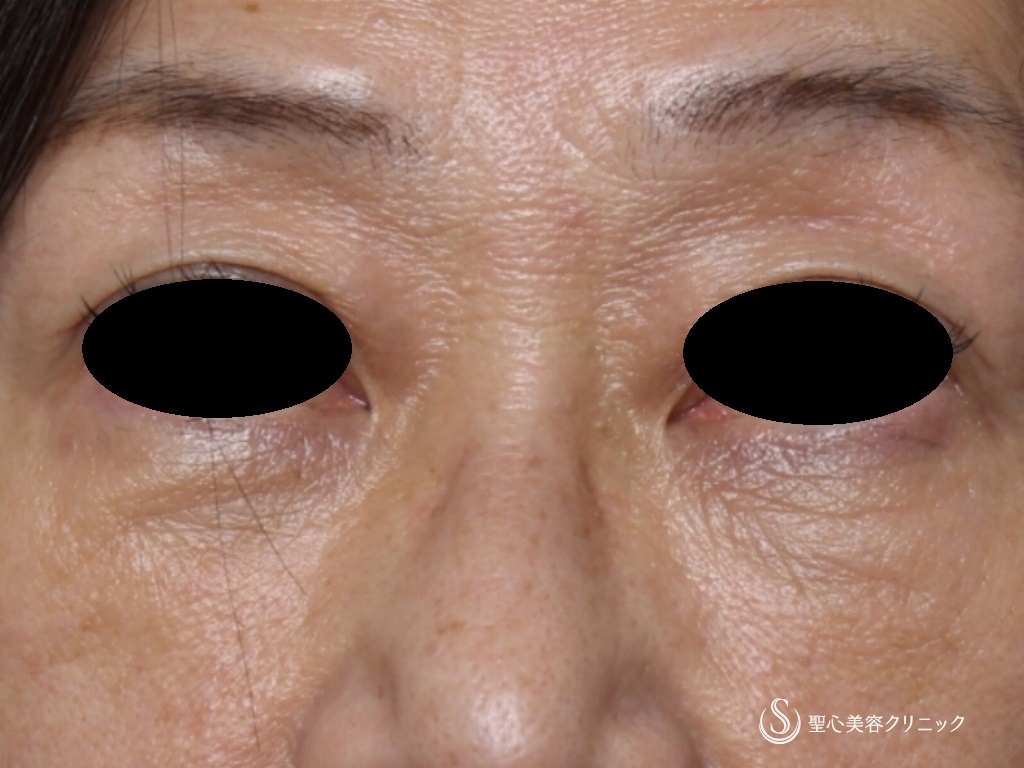 【60代女性・目の下の若返り】結膜側脱脂+プレミアムＰＲＰ皮膚再生療法（1か月後） After 
