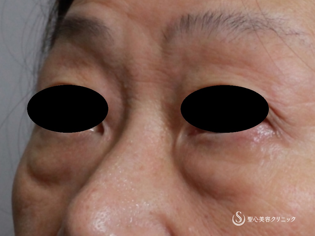 【60代女性・目の下の若返り】結膜側脱脂+プレミアムＰＲＰ皮膚再生療法（1か月後） Before 