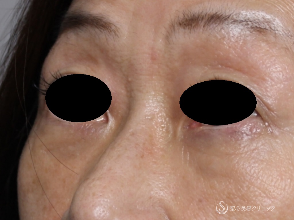 【60代女性・目の下の若返り】結膜側脱脂+プレミアムＰＲＰ皮膚再生療法（1か月後） After 