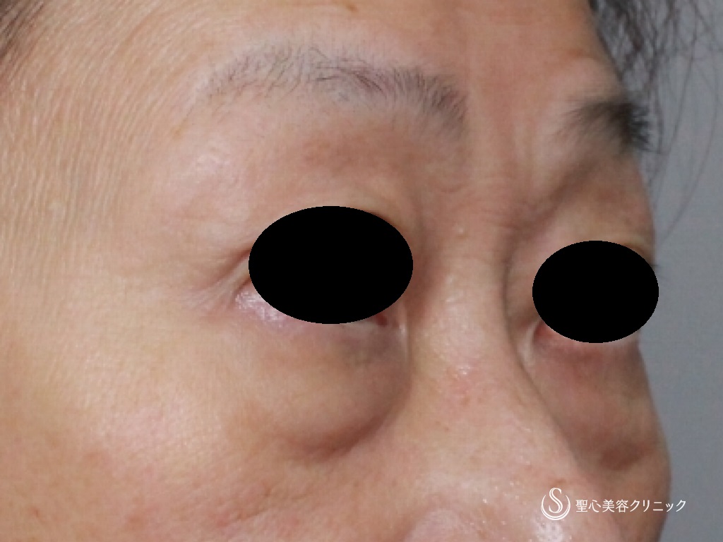 【60代女性・目の下の若返り】結膜側脱脂+プレミアムＰＲＰ皮膚再生療法（1か月後） Before 