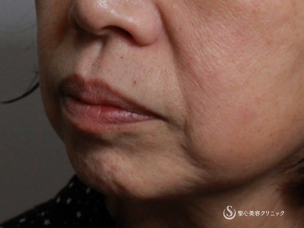 60代女性 法令線 マリオネットラインの治療 プレミアムｐｒｐ皮膚再生療法 1か月後 症例写真 美容整形 美容外科なら聖心美容クリニック