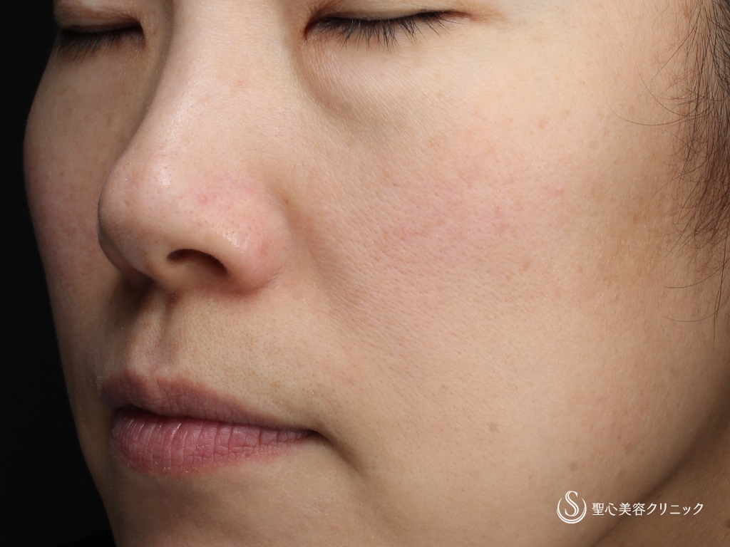 【女性・赤ら顔の治療】585 Quanta System Q1モニター（２回照射後１か月） Before 