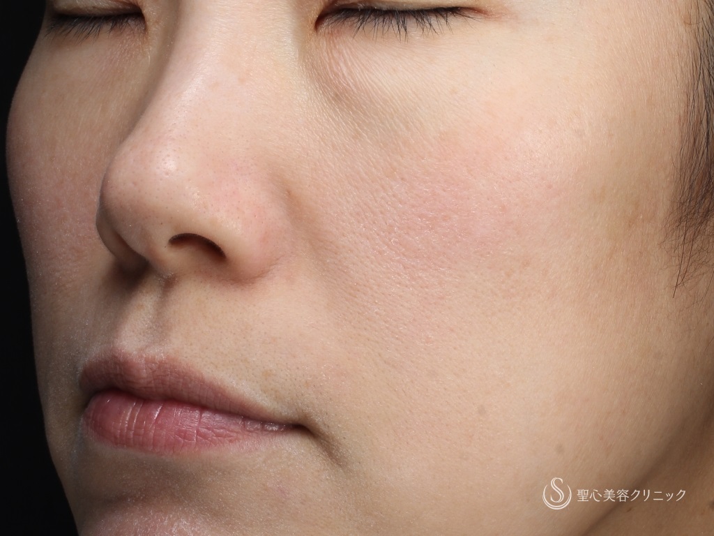 【女性・赤ら顔の治療】585 Quanta System Q1モニター（２回照射後１か月） After 
