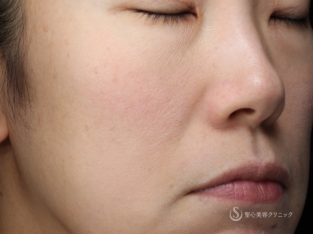 【女性・赤ら顔の治療】585 Quanta System Q1モニター（２回照射後１か月） After 