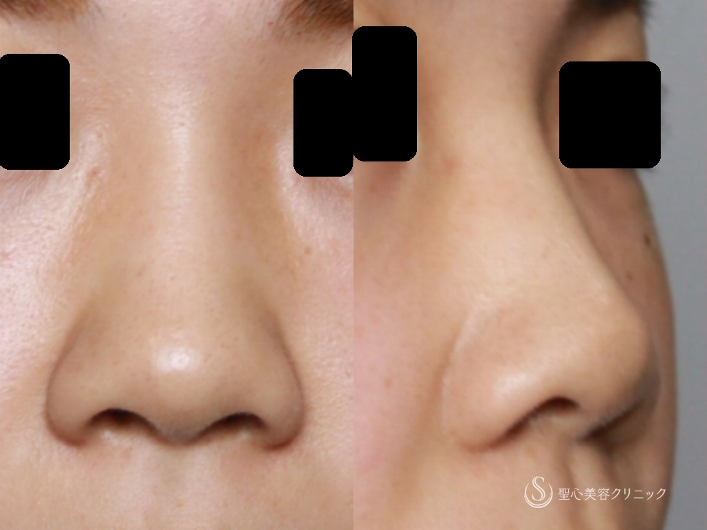 【20代女性・鼻を高く、鼻先の丸みと小鼻を小さく改善】鼻プロテーゼ+鼻尖縮小+鼻尖形成（３DPCLドーム）+小鼻縮小（1か月後） Before 