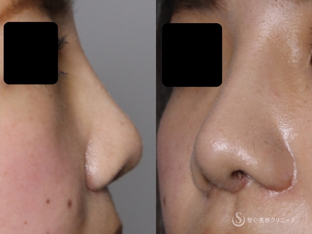 【20代女性・鼻を高く、鼻先の丸みと小鼻を小さく改善】鼻プロテーゼ+鼻尖縮小+鼻尖形成（３DPCLドーム）+小鼻縮小（1か月後） After 