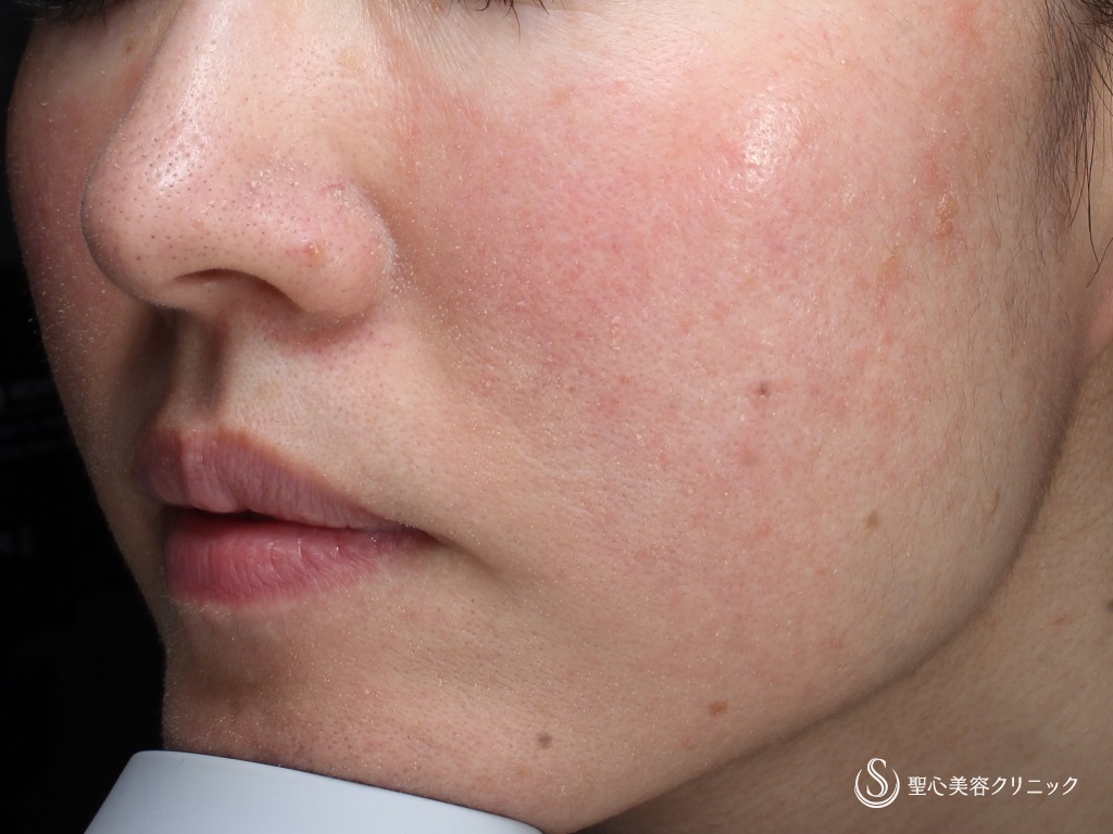 【40代女性・赤ら顔の治療】585 Quanta System Q1モニター（3回照射後1か月） Before 