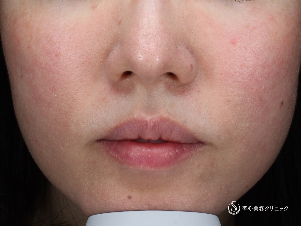 【40代女性・赤ら顔の治療】585 Quanta System Q1モニター（3回照射後1か月） After 