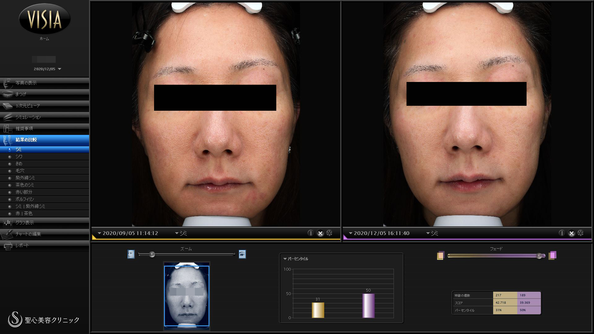 【40代女性・赤ら顔の治療】585 Quanta System Q1モニター（3回後） Before 