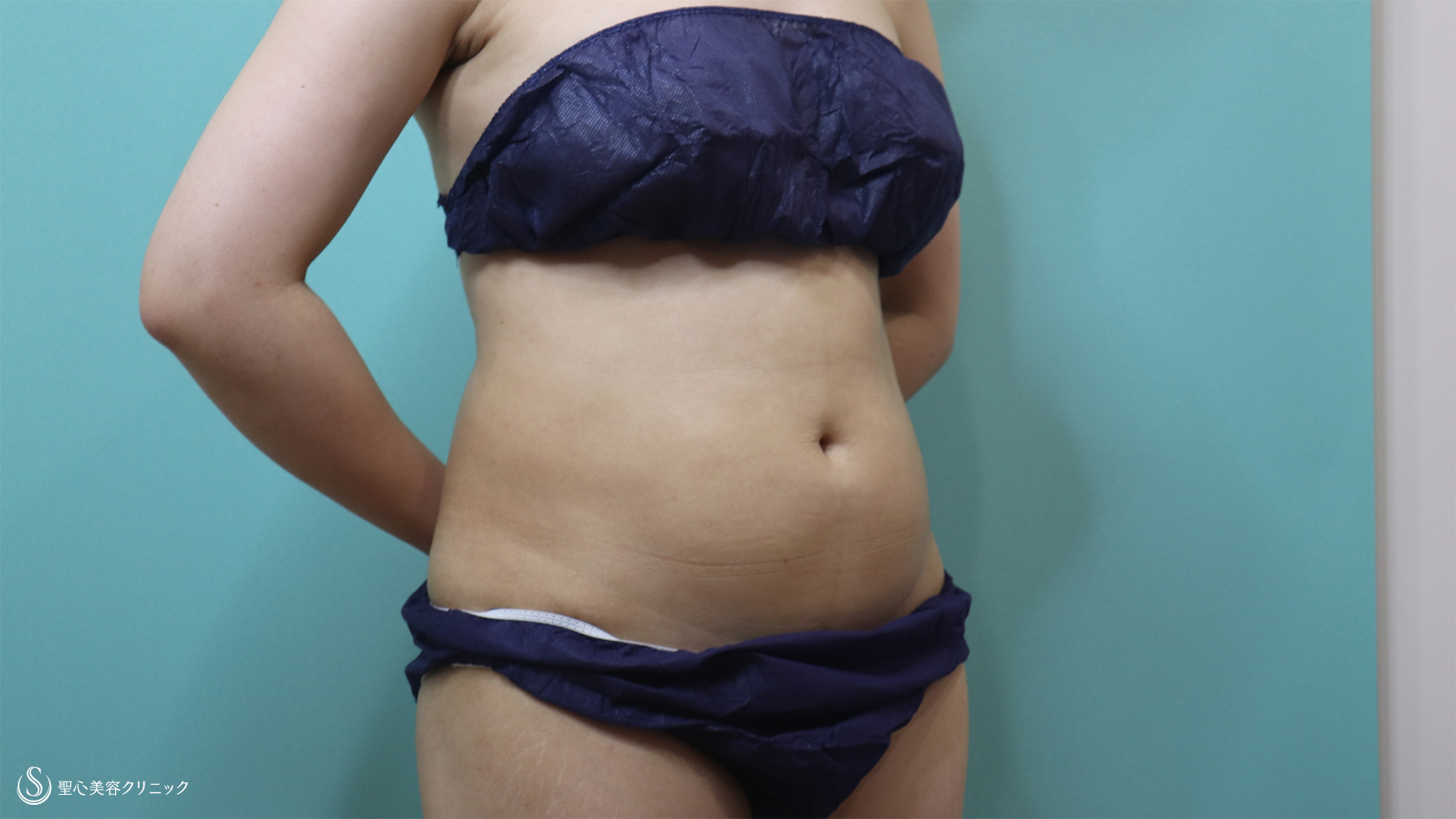 【30代女性・腹部の脂肪吸引】ベイザーリポ2.2脂肪吸引（1ヶ月後） Before 