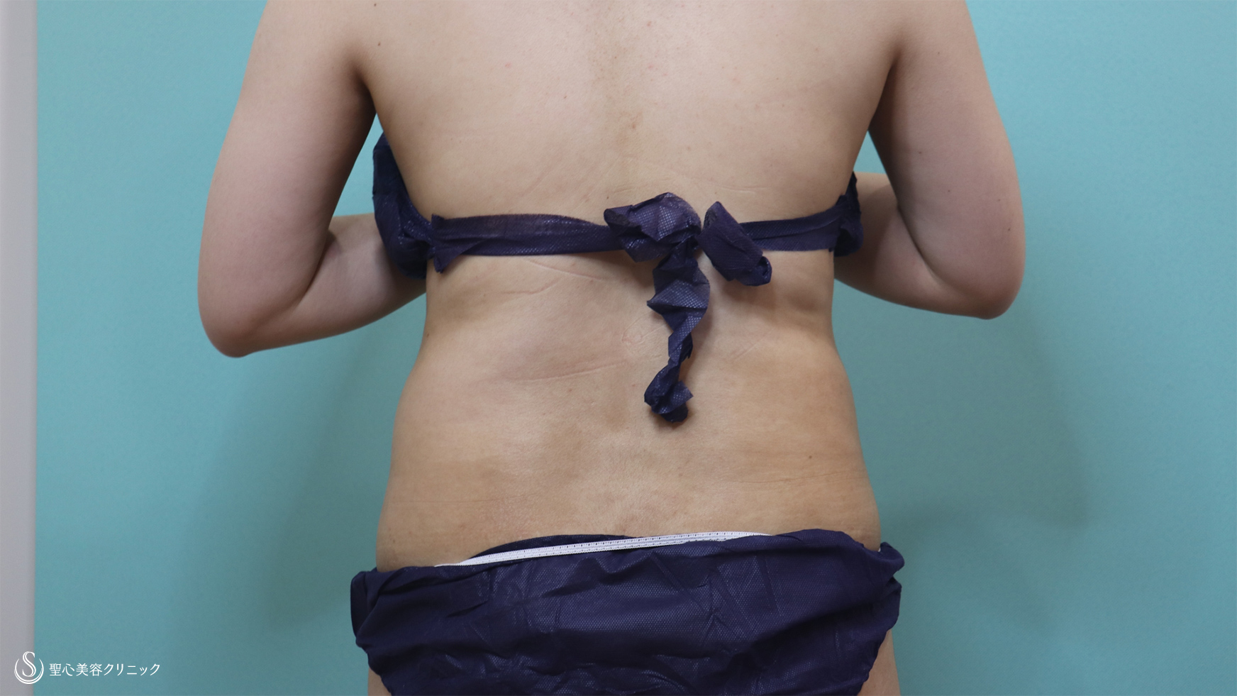 【30代女性・腹部の脂肪吸引】ベイザーリポ2.2脂肪吸引（1ヶ月後） Before 