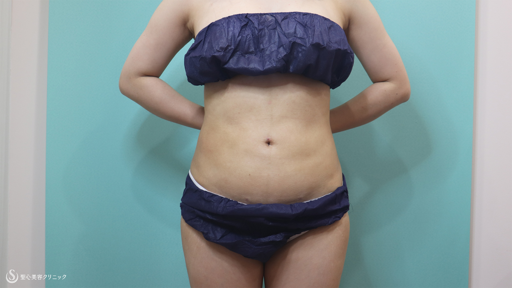 【30代女性・腹部の脂肪吸引】ベイザーリポ2.2脂肪吸引（1ヶ月後） After 