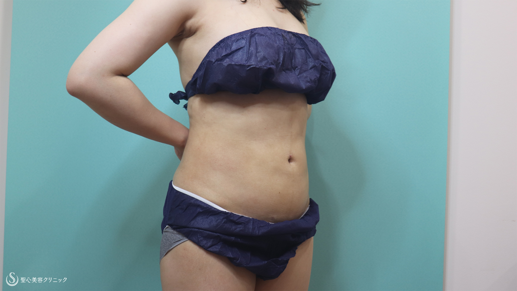 【30代女性・腹部の脂肪吸引】ベイザーリポ2.2脂肪吸引（1ヶ月後） After 