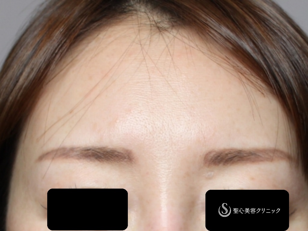 【40代女性・額、眉間をふっくらと若々しく】プレミアムPRP皮膚再生療法（4ヶ月後） Before 