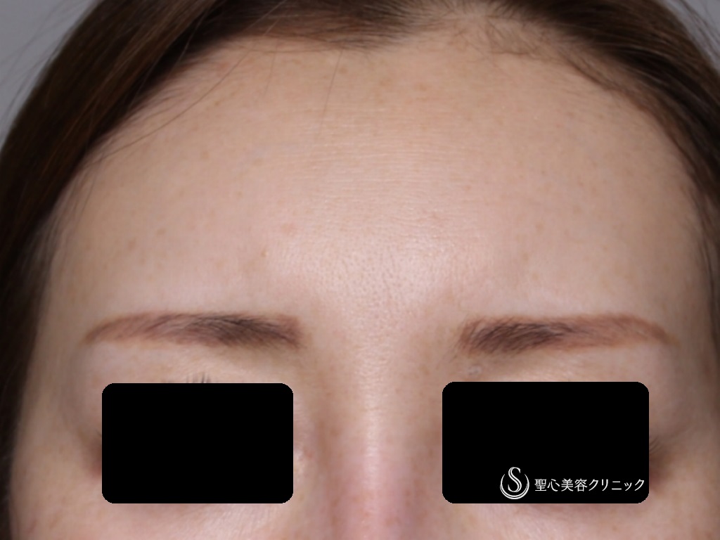 【40代女性・額、眉間をふっくらと若々しく】プレミアムPRP皮膚再生療法（4ヶ月後） After 