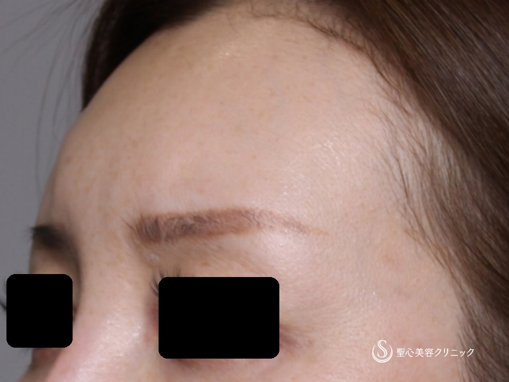 【40代女性・額、眉間をふっくらと若々しく】プレミアムPRP皮膚再生療法（4ヶ月後） After 