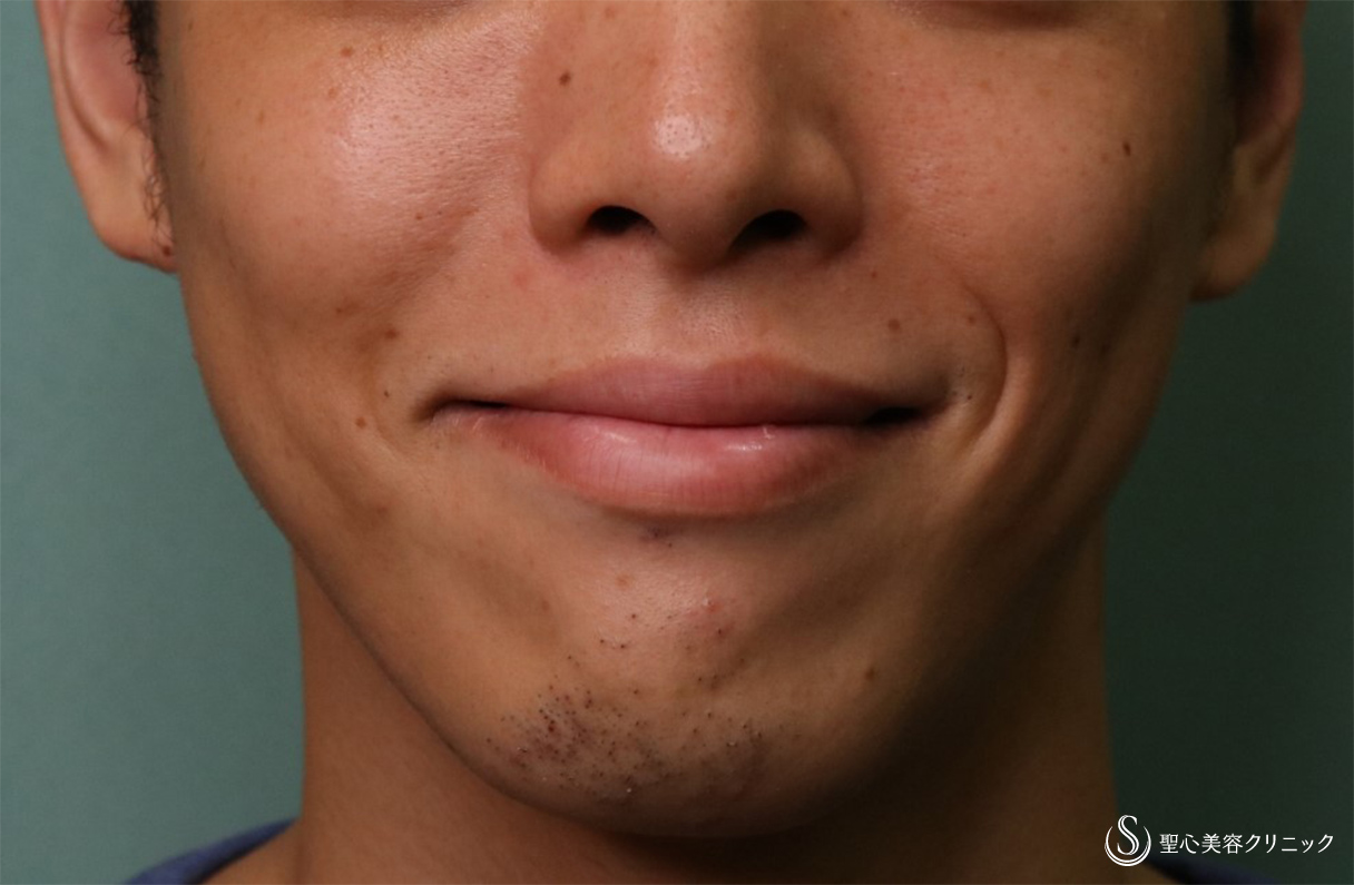 【20代男性・口横の表情じわ】プレミアムPRP皮膚再生療法（4ヶ月後） Before 
