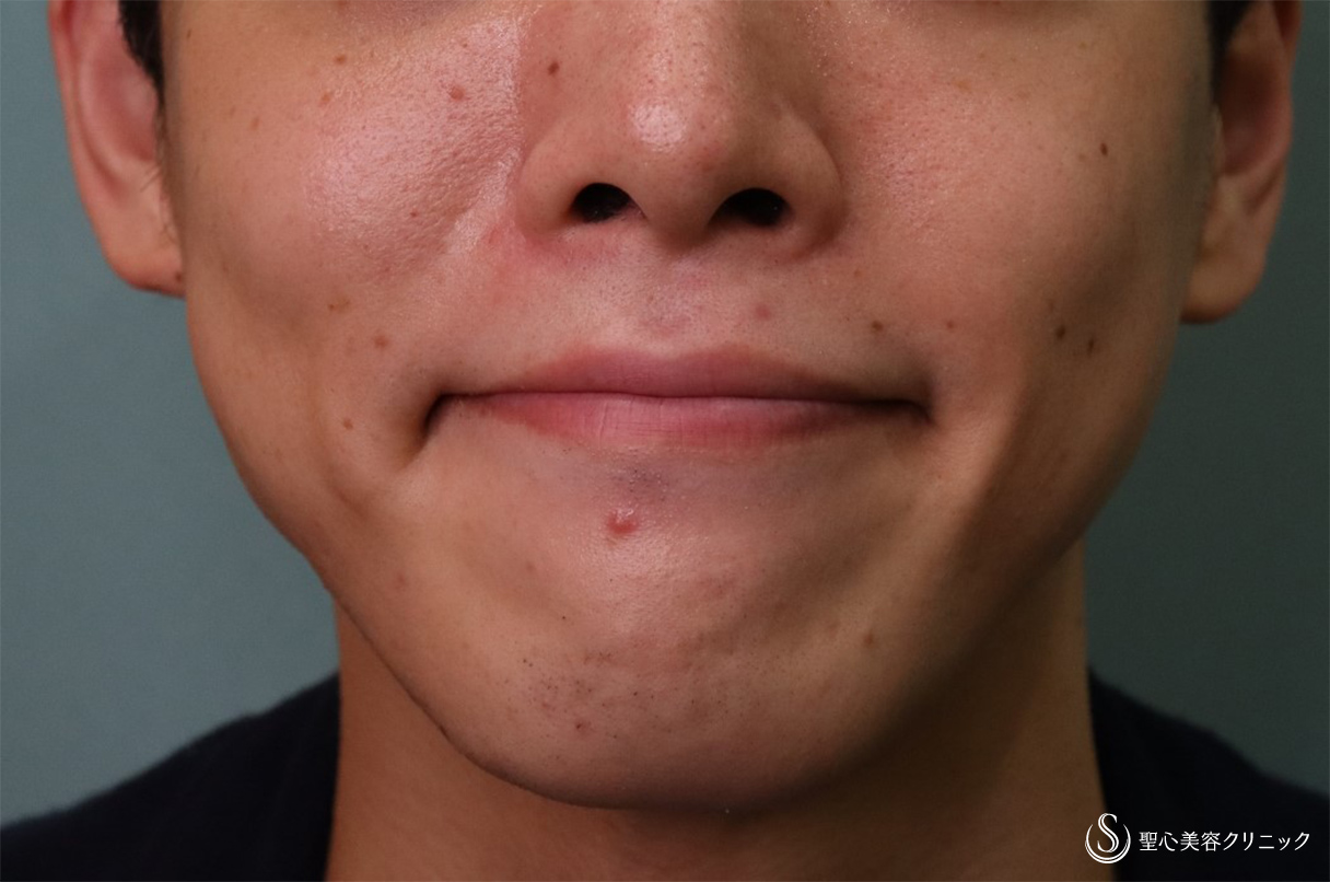 【20代男性・口横の表情じわ】プレミアムPRP皮膚再生療法（4ヶ月後） After 