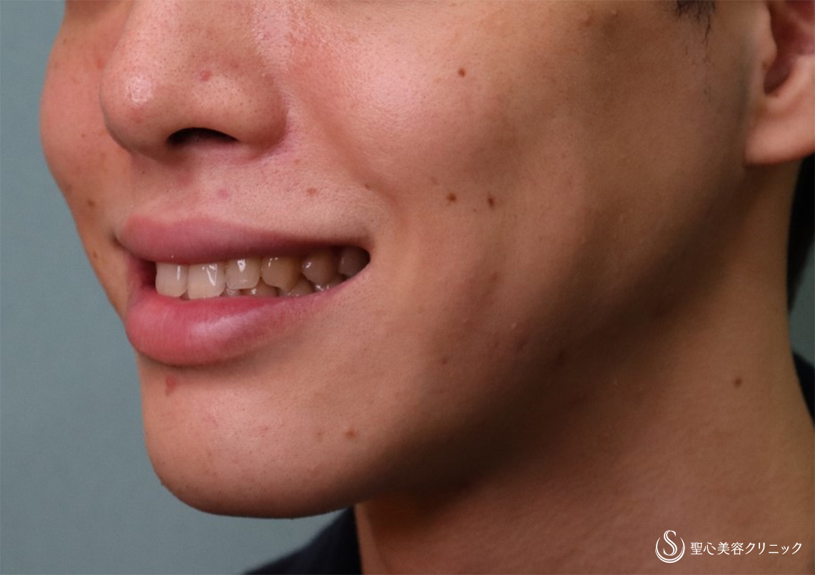 【20代男性・口横の表情じわ】プレミアムPRP皮膚再生療法（4ヶ月後） After 