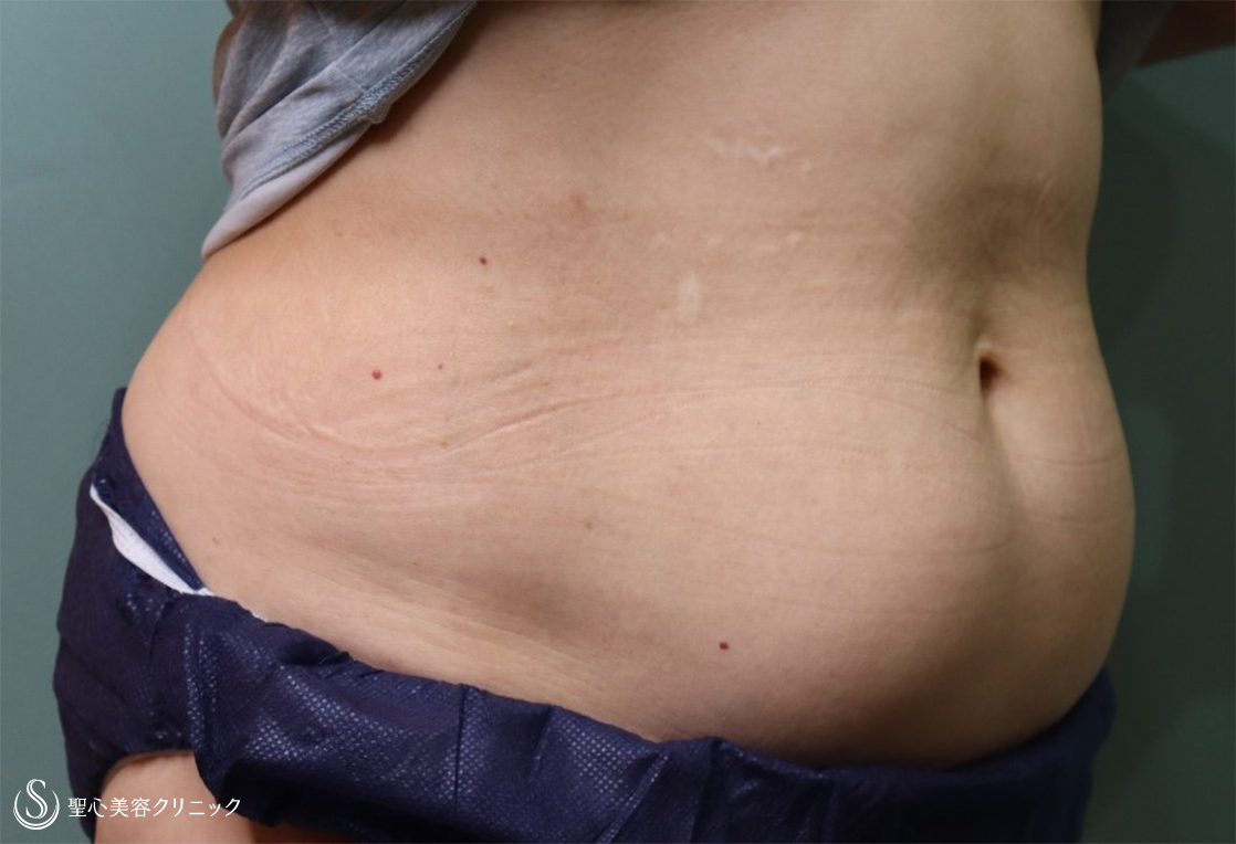 【70代女性・腹部痩身】リポセル（3ヶ月後） Before 