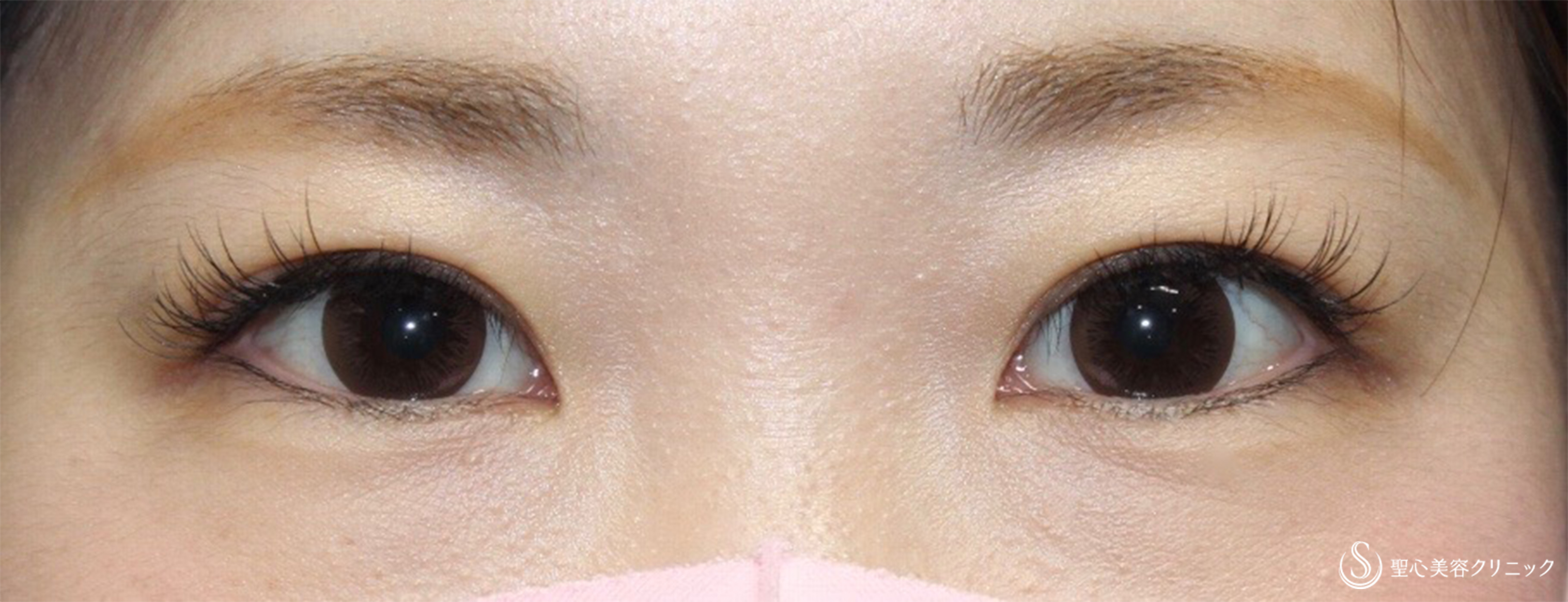 【20代女性・ダウンタイム少なく綺麗な瞼へ】マイクロメソッド＋α（術後1ヶ月） After 