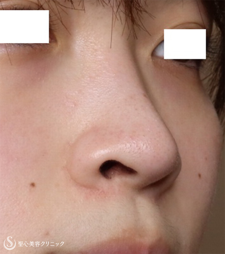 【20代女性・鼻の穴を目立たなく】小鼻縮小（1週間後） Before 