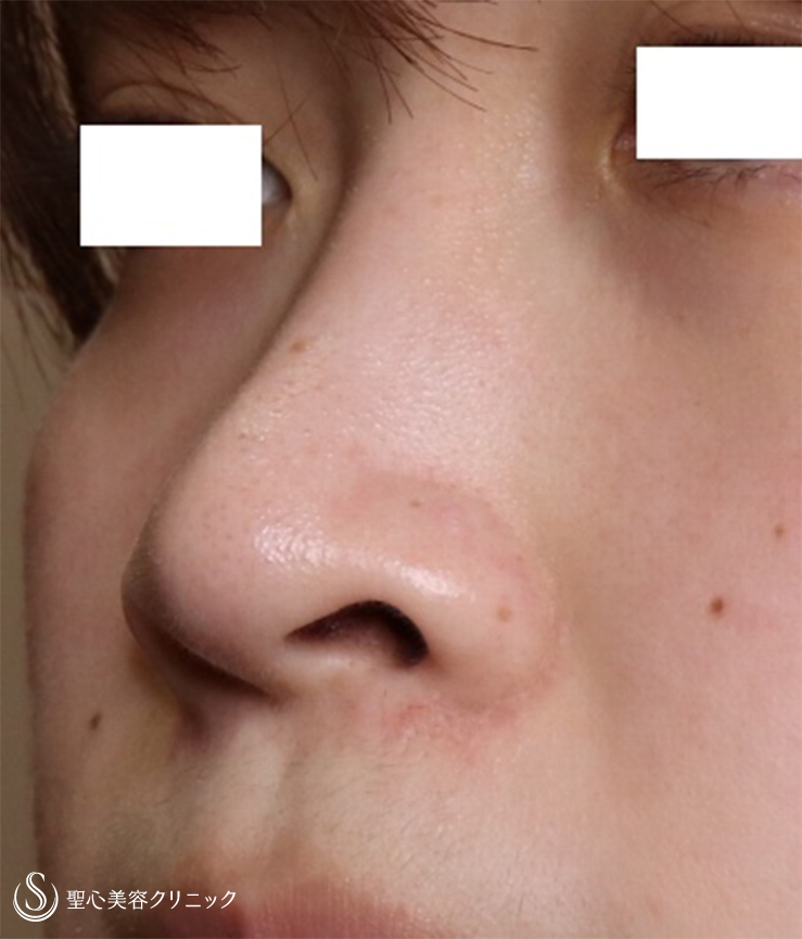 【20代女性・鼻の穴を目立たなく】小鼻縮小（1週間後） Before 