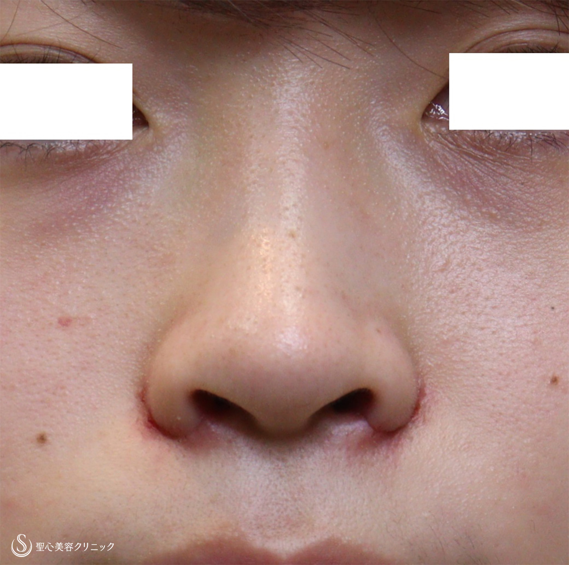 代女性 鼻の穴を目立たなく 小鼻縮小 1週間後 症例写真 美容整形 美容外科なら聖心美容クリニック
