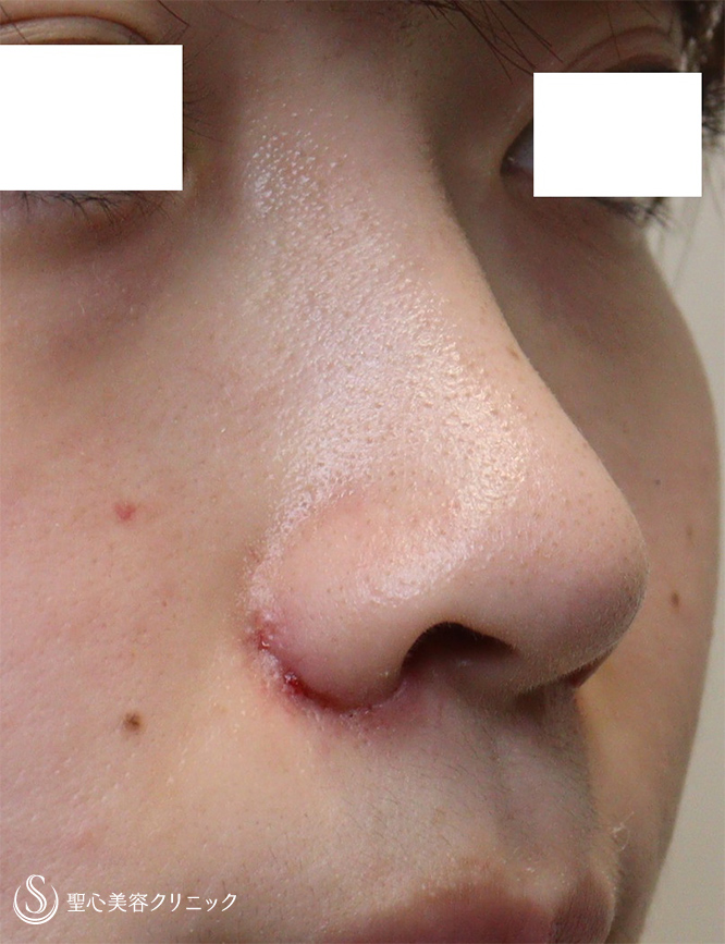 【20代女性・鼻の穴を目立たなく】小鼻縮小（1週間後） After 
