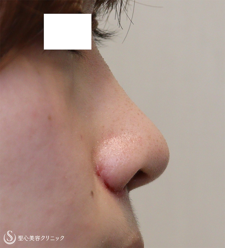 【20代女性・鼻の穴を目立たなく】小鼻縮小（1週間後） After 