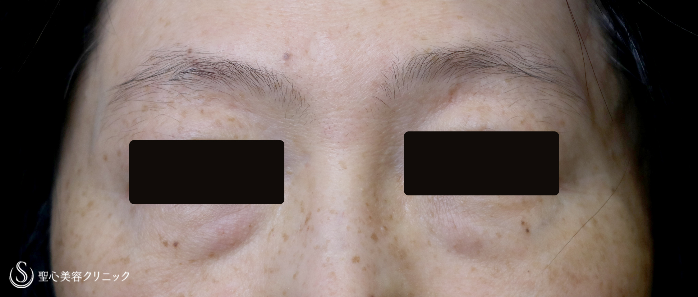 【50代女性・目の下のくまを改善】経結膜下脱脂、プレミアムPRP皮膚再生療法（4ヶ月後） Before 