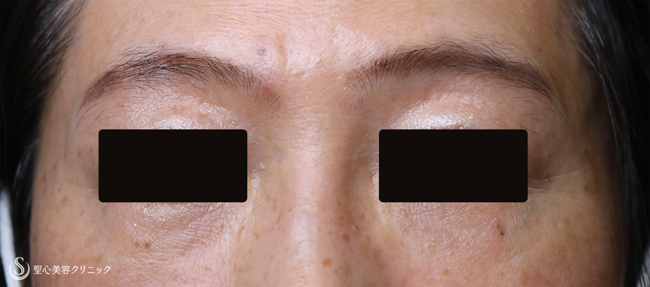 【50代女性・目の下のくまを改善】経結膜下脱脂、プレミアムPRP皮膚再生療法（4ヶ月後） After 