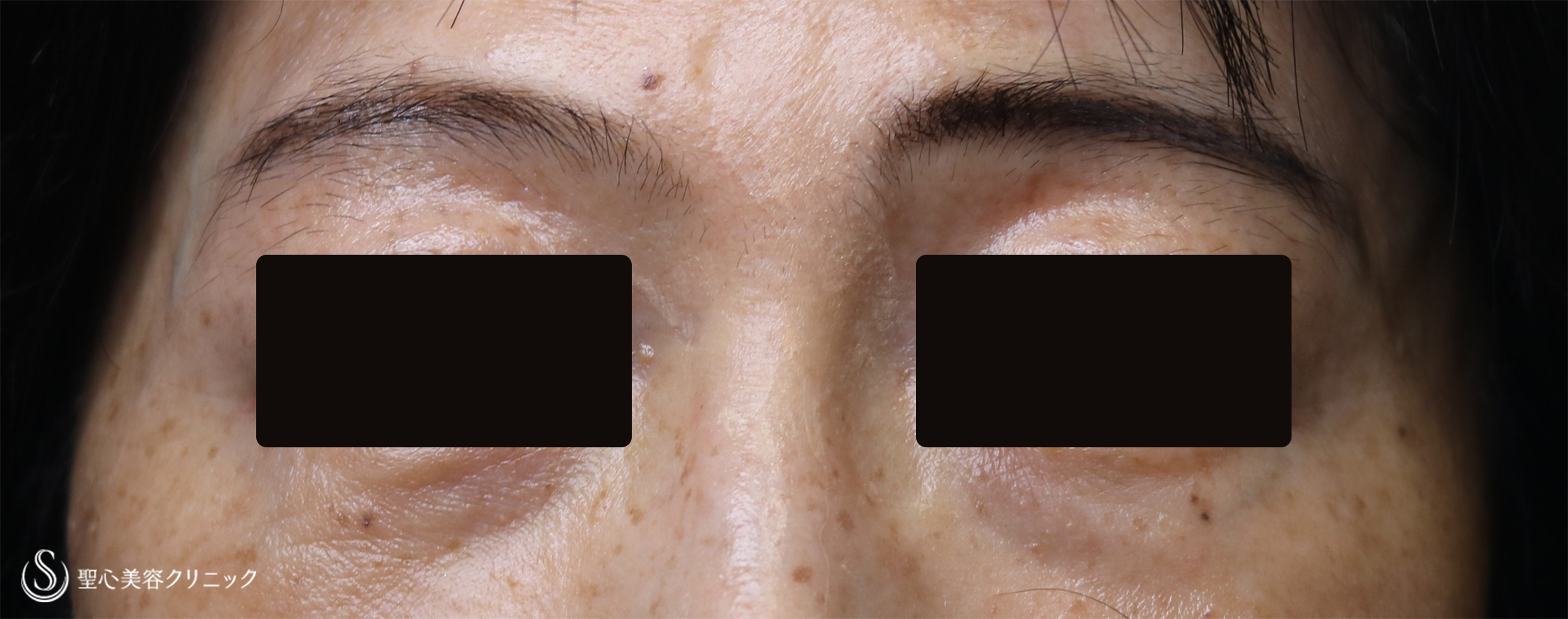 【50代女性・目の下のくまを改善】経結膜下脱脂、プレミアムPRP皮膚再生療法（4ヶ月後） After 