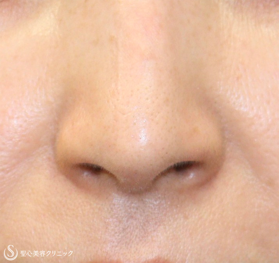 【50代女性・鼻の穴が見えるのが気になる】鼻孔縁下降術 After 