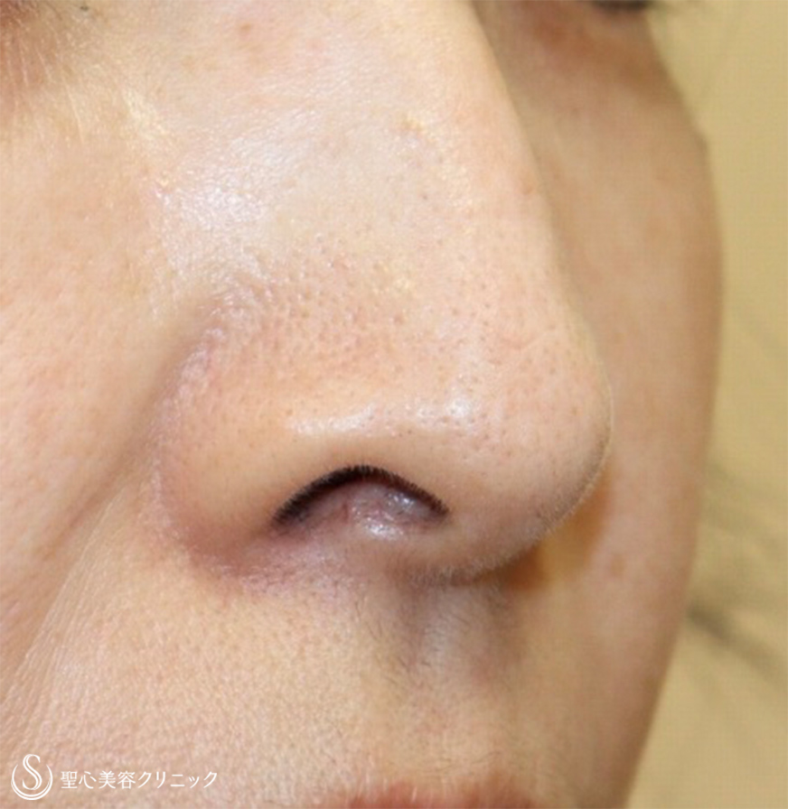 【50代女性・鼻の穴が見えるのが気になる】鼻孔縁下降術 Before 