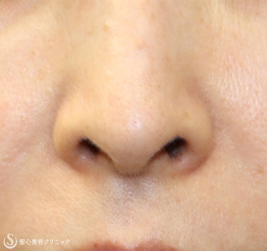 【50代女性・鼻の穴が見えるのが気になる】鼻孔縁下降術 Before 
