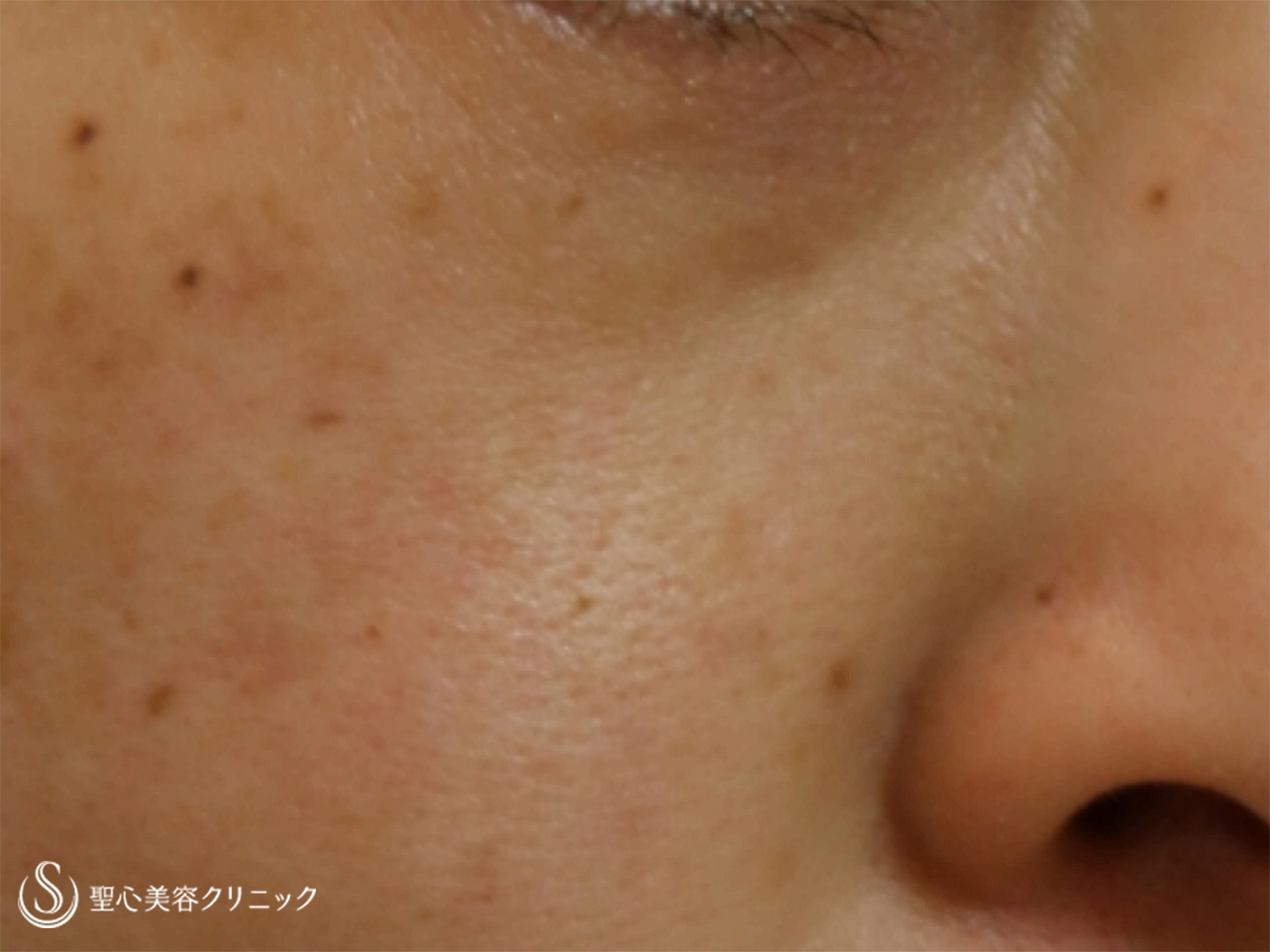 【50代女性・目の下の凹み】プレミアムPRP皮膚再生療法（19か月後） Before 