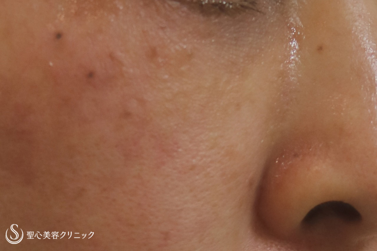 【50代女性・目の下の凹み】プレミアムPRP皮膚再生療法（19か月後） After 