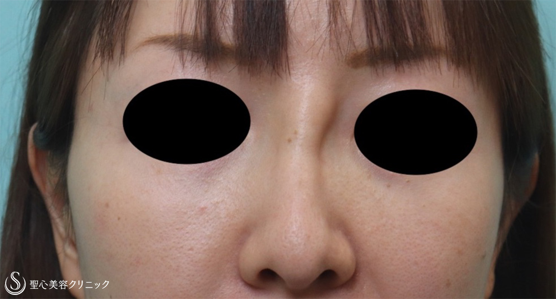 【30代女性・鼻のアクアミドを除去し、綺麗に】鼻のアクアミド 除去（3日後） Before 