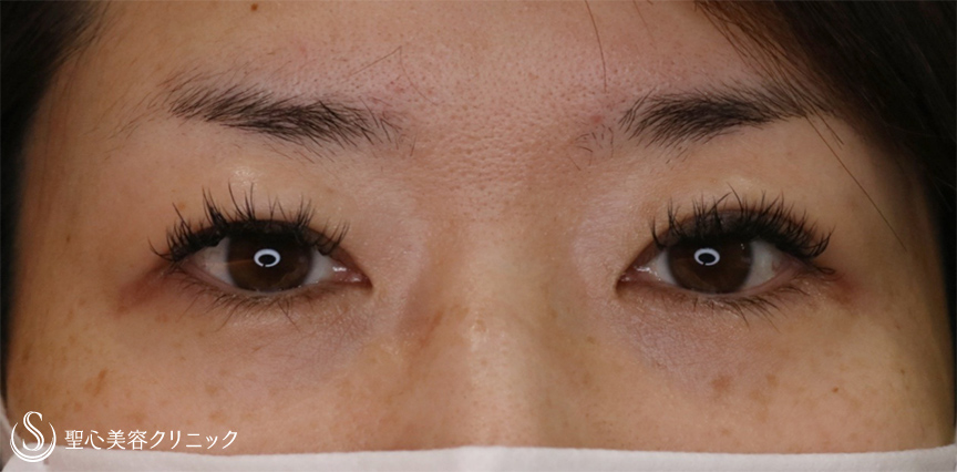 【30代女性・頭痛薬が要らなくなった】眉下切開法（1ヶ月後、修正5ヶ月後） Before 